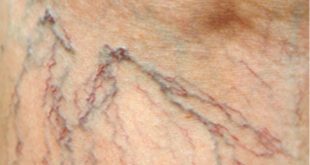 Understanding Spider Veins