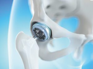 Recovery After Hip Replacement