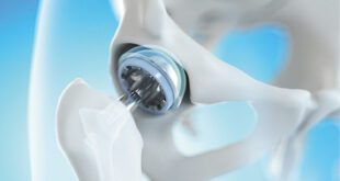 Recovery After Hip Replacement