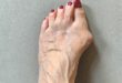 Relief from Bunions
