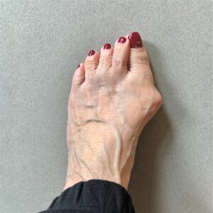 Relief from Bunions