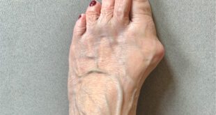 Relief from Bunions