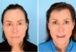 Before and after FUE Hair Transplant by Dr. Alan Bauman