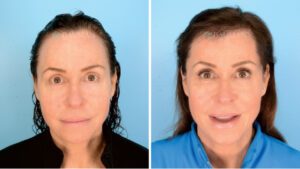 Before and after FUE Hair Transplant by Dr. Alan Bauman