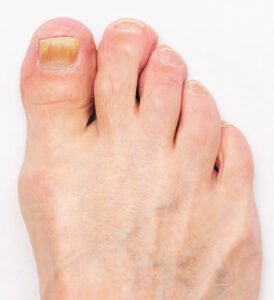 Toenail Fungus 