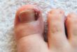 Ingrown Toenails