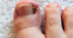 Ingrown Toenails