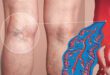 CHRONIC VENOUS INSUFFICIENCY