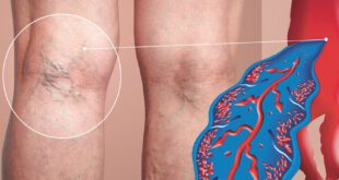 CHRONIC VENOUS INSUFFICIENCY
