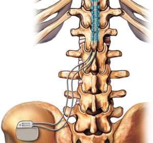 Spinal Cord Stimulation