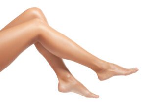 Varicose Veins