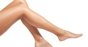 Varicose Veins