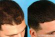 Bauman Medical Helps Men Get Their Swagger Back