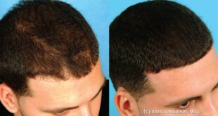 Bauman Medical Helps Men Get Their Swagger Back