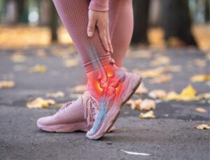 Radiation Therapy for Plantar Fasciitis