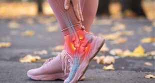 Radiation Therapy for Plantar Fasciitis