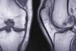 Joint Injuries