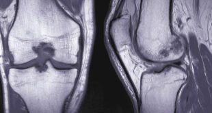 Joint Injuries