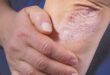 Understanding Psoriasis