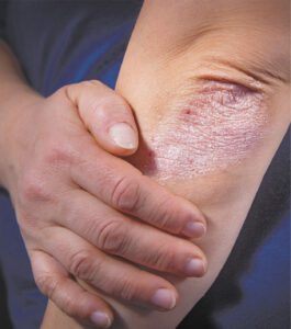 Understanding Psoriasis