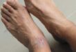 Venous Leg Ulcers