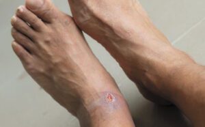 Venous Leg Ulcers