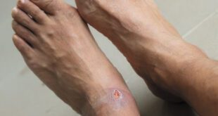 Venous Leg Ulcers